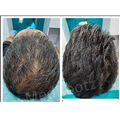 Non-Surgical Voluminous Hair Treatment