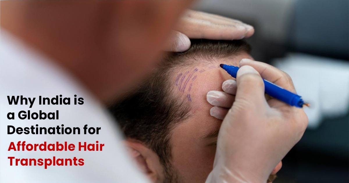 Best Hair Transplant in India