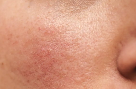 Rosacea