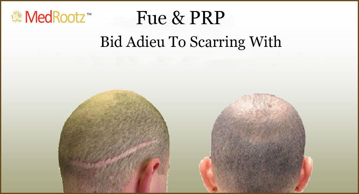 Best hair transplant in delhi