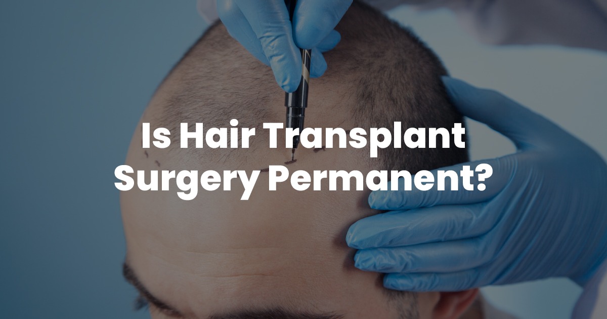 Is Hair Transplant Surgery Permanent? - MedRootz