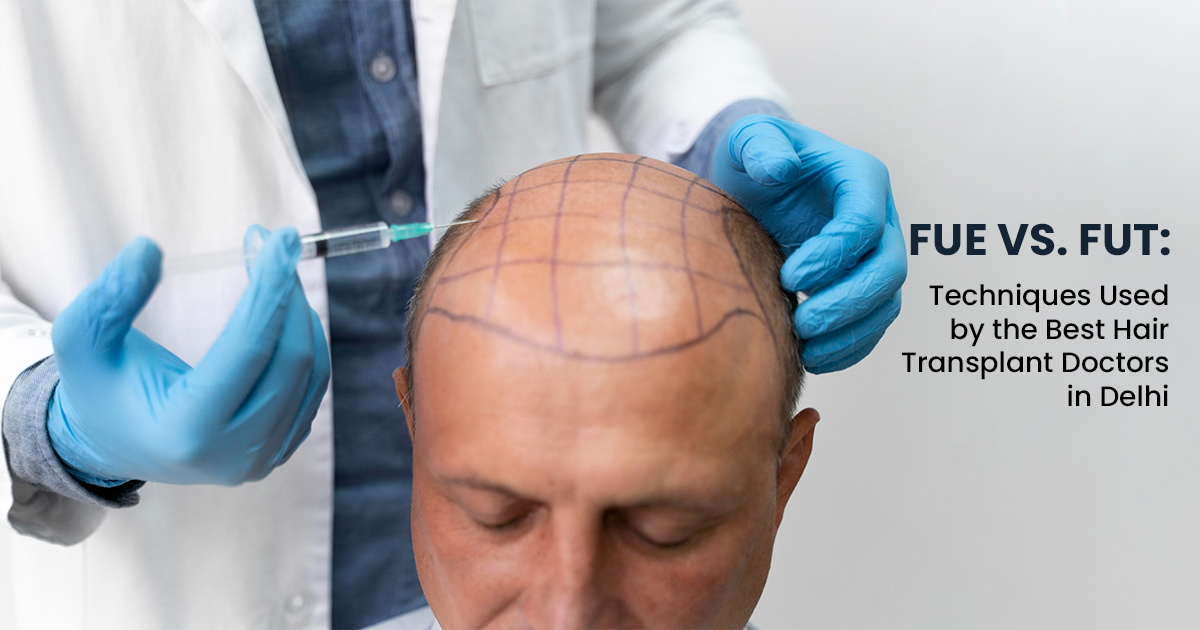 FUE vs. FUT: Techniques Used by the Best Hair Transplant Doctors in Delhi