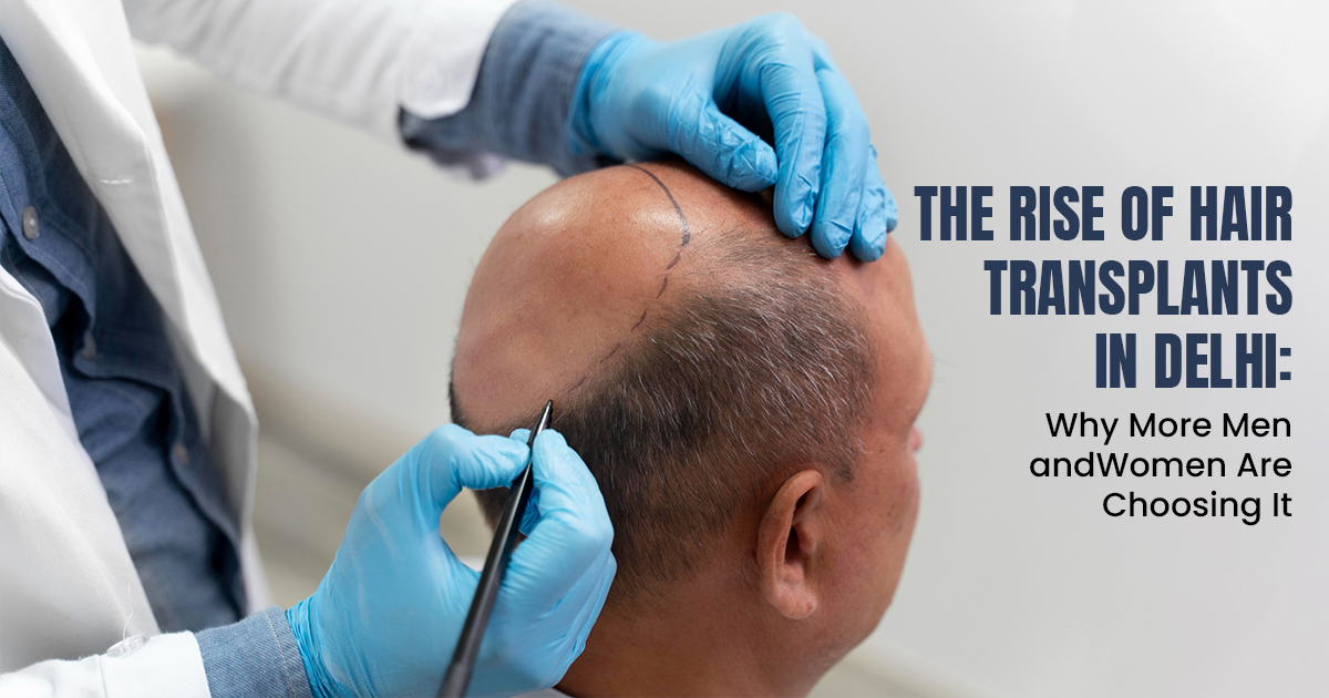 The Rise of Hair Transplants in Delhi: Why More Men and Women Are Choosing It